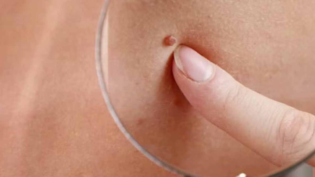 epitheloides Angiosarkom